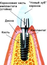 Имплантация